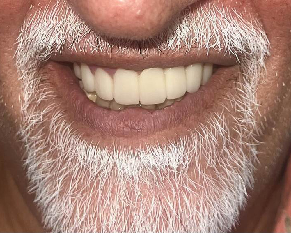 Post-treatment — Three-year follow-up