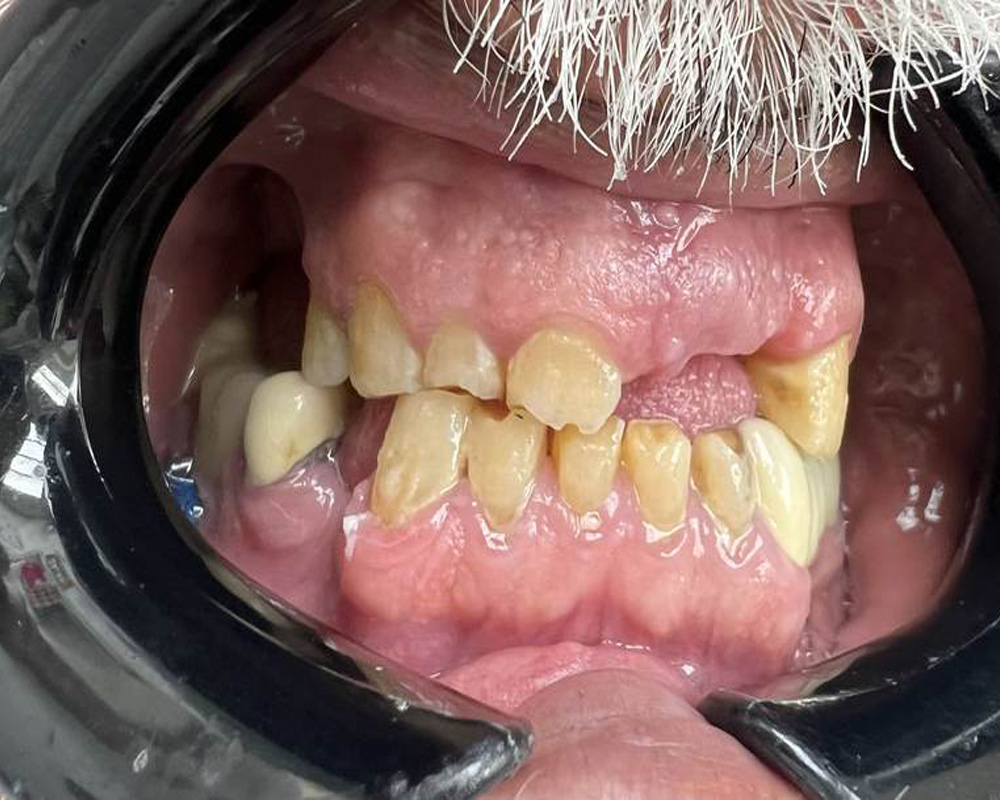 Pre-Treatment