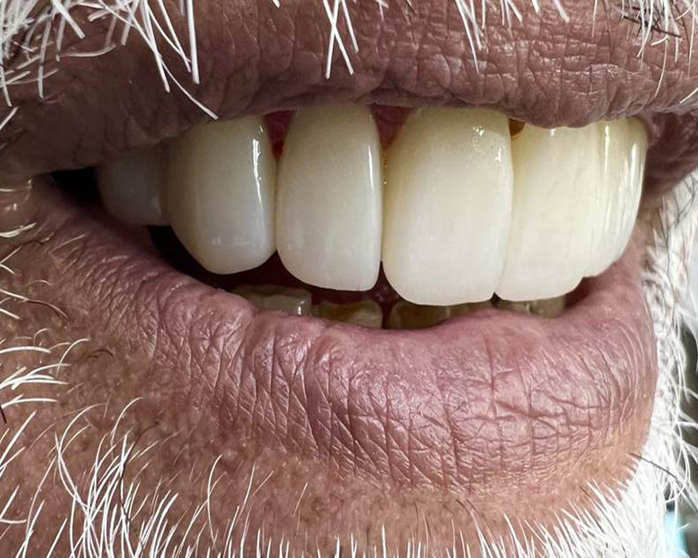 Post-treatment — Three-year follow-up