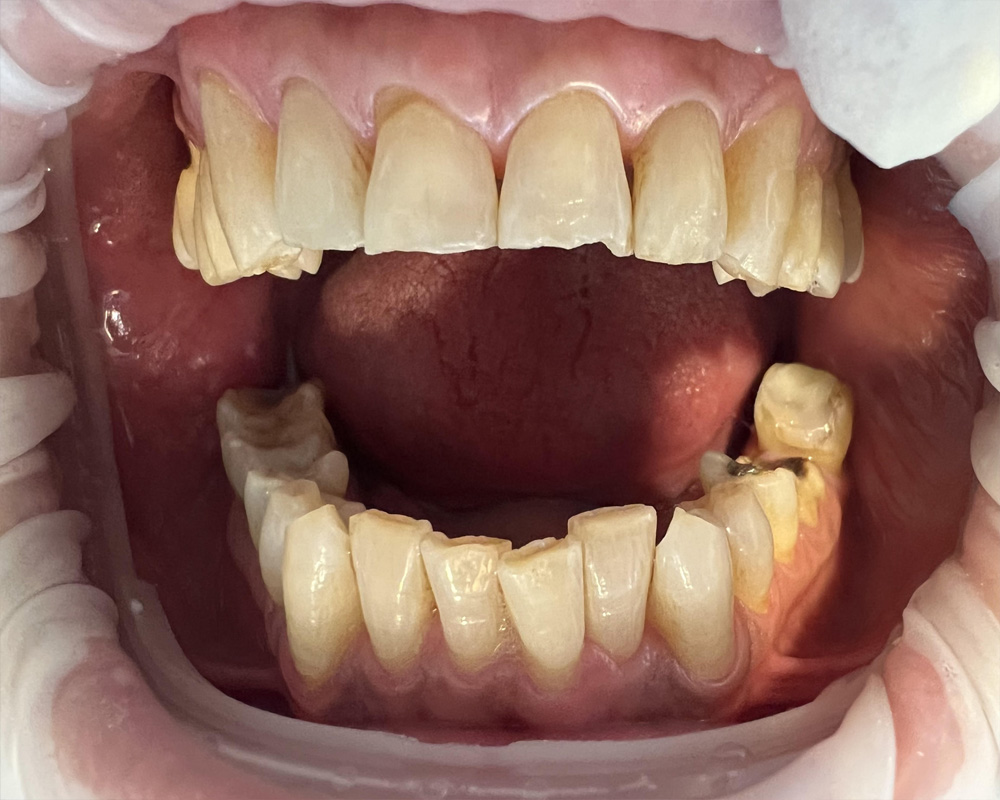 Pre-treatment — Initial intraoral view