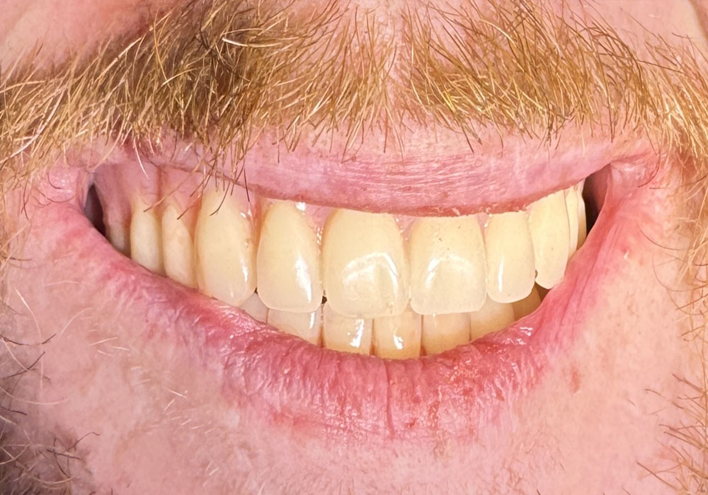 Post-Treatment - Maxillary and mandibular implant-supported overdenture rehabilitation