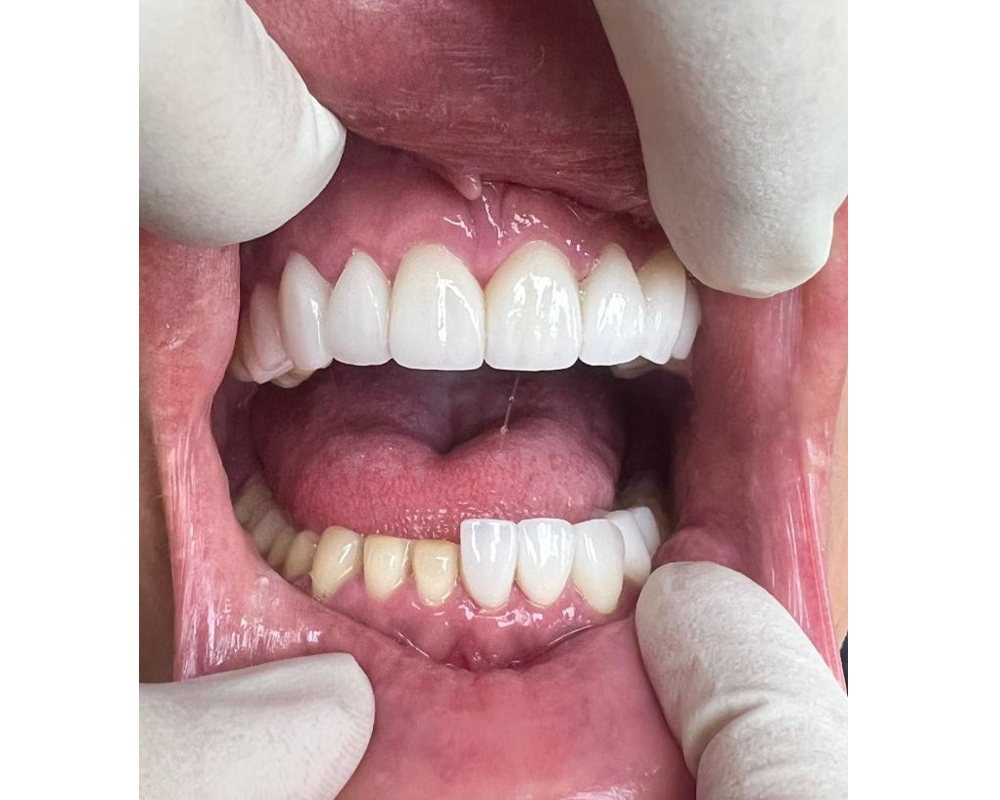 Veener delivery stage - Prepared teeth on the image left: veeners seated on the remaining teeth