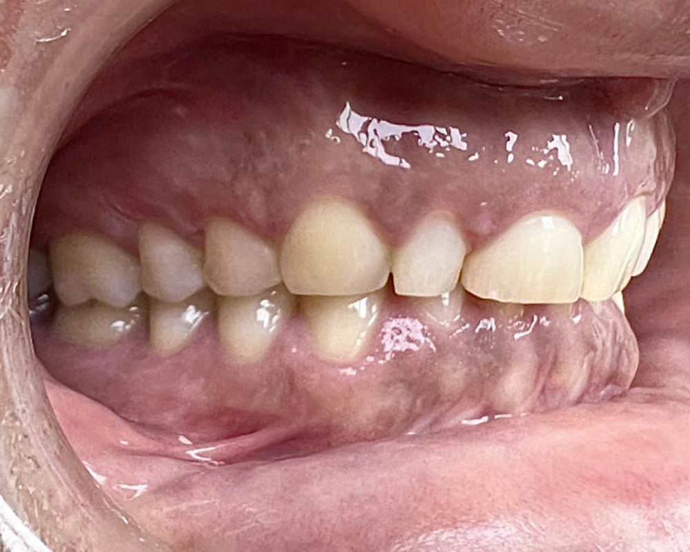 Initial consultation — Lateral intraoral view showing severe tooth wear