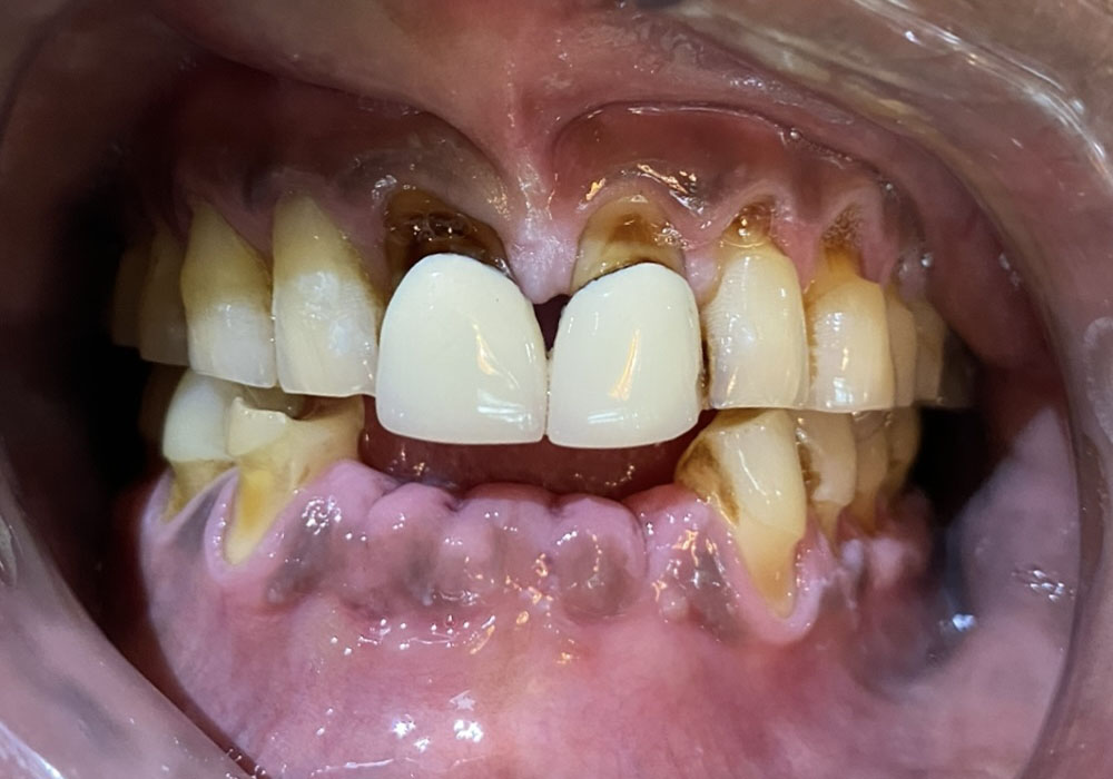 Pre-Treatment - Full-mouth crown-and-bridge rehabilitation