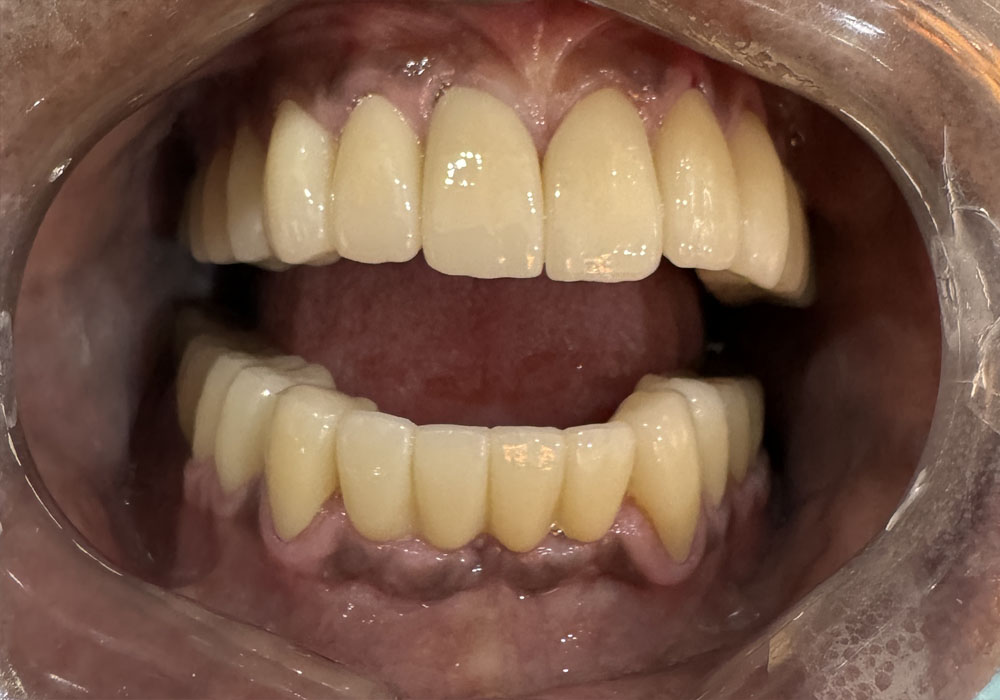 Post-Treatment - Full-mouth rehabilitation with monolithic zirconia crown and bridges