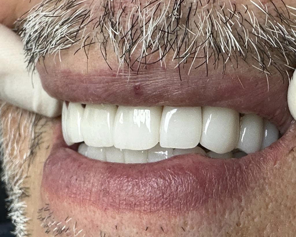 Post treatment - Three year follow up