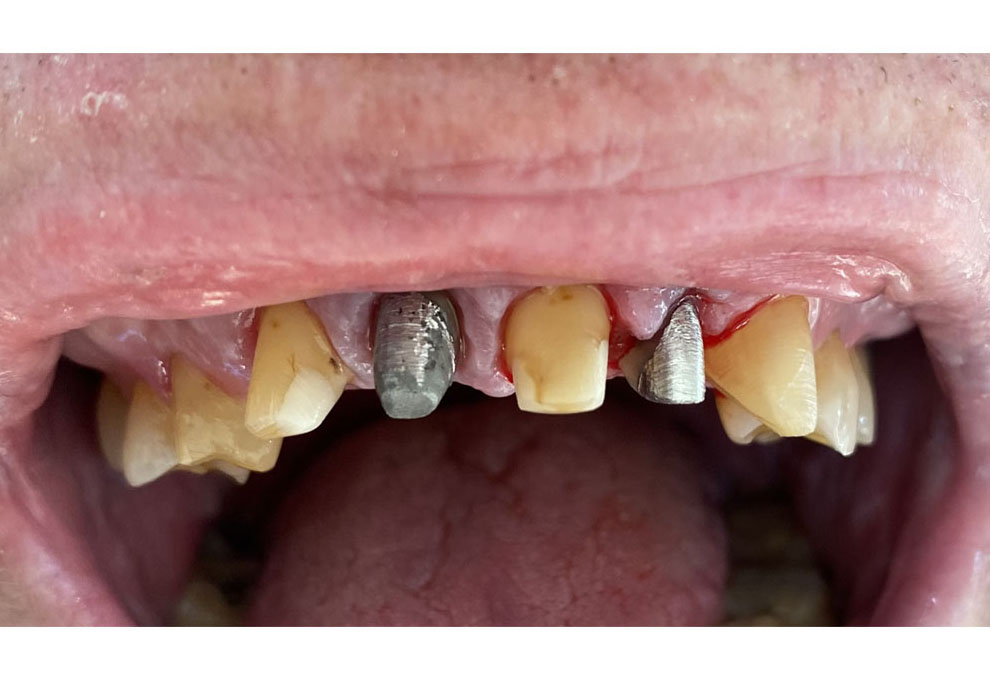 Treatment stage — Cast post-and-core restorations and prepared maxillary teeth