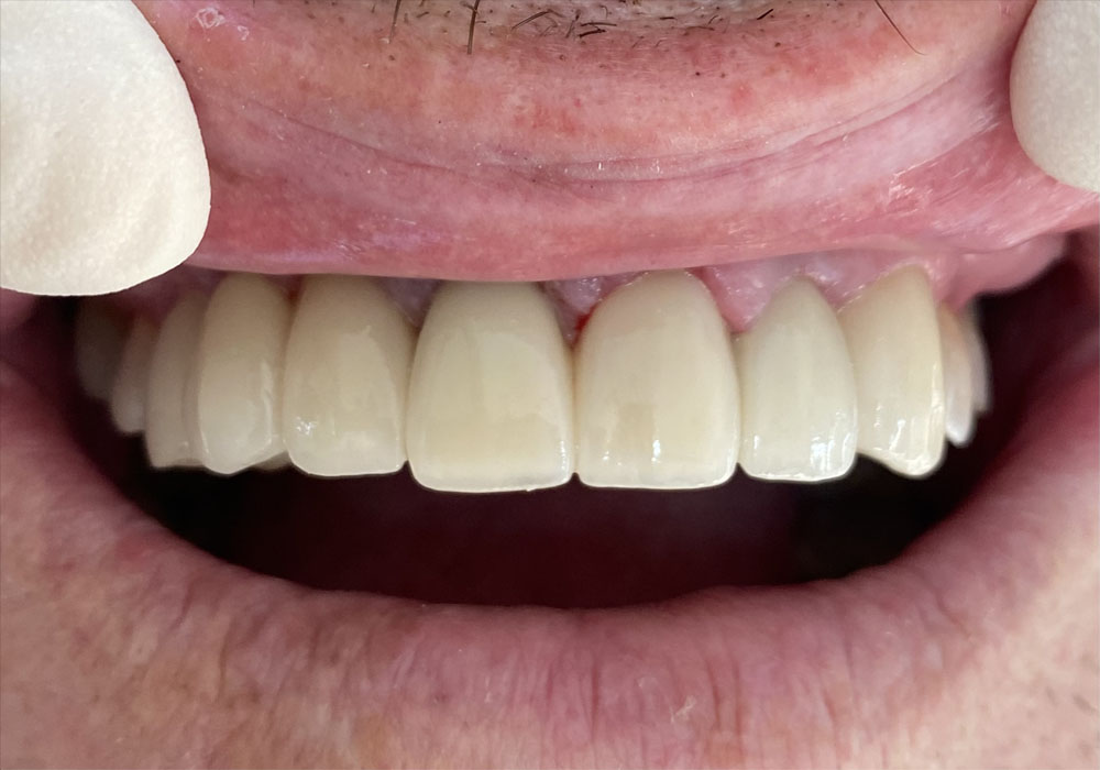 Post-Treatment