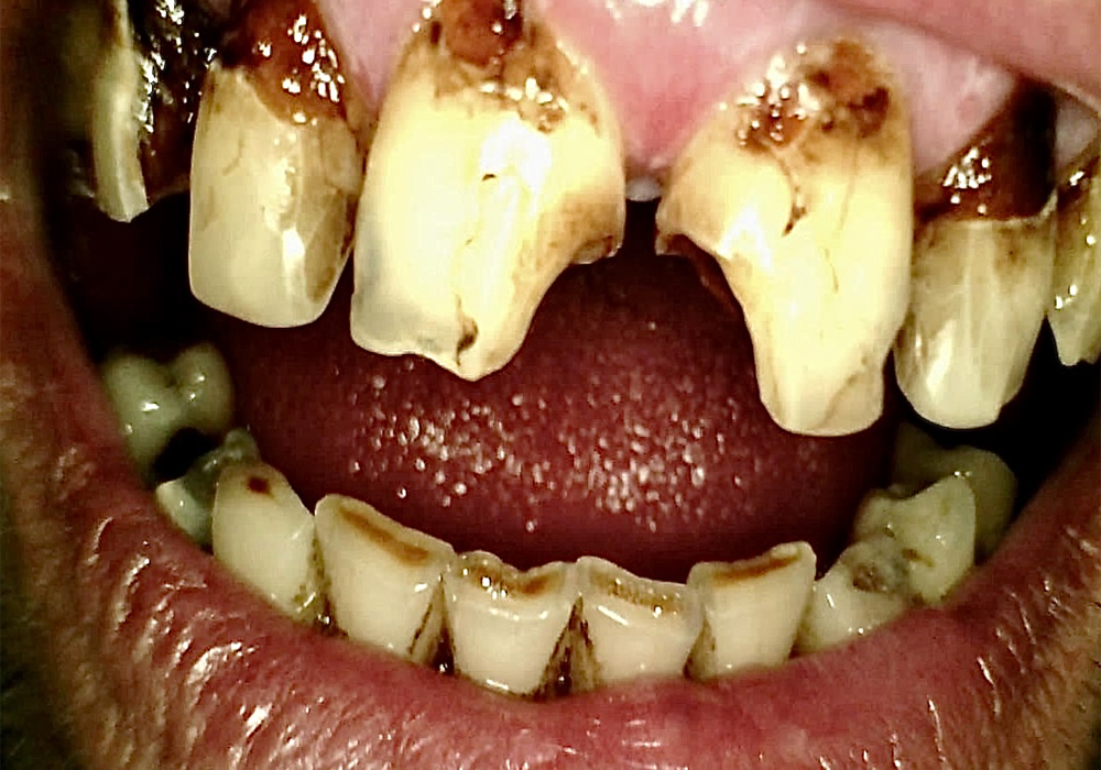 PRE-TREATMENT - Initial presentation — Comprehensive maxillary restorative rehabilitation