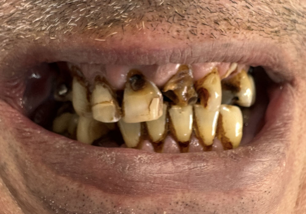 PRE-TREATMENT - Initial presentation — Frontal smile view before restorative rehabilitation of the maxillary and mandibular arches